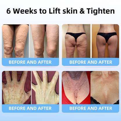 🔥👩‍⚕️𝐋𝐚𝐬𝐭 𝐃𝐚𝐲 𝐃𝐢𝐬𝐜𝐨𝐮𝐧𝐭: 𝟕5% 𝐎𝐅𝐅✨𝑺𝑷𝒁𝑽™ 𝑺𝒌𝒊𝒏 𝑳𝒊𝒇𝒕𝒊𝒏𝒈 𝑾𝒓𝒊𝒏𝒌𝒍𝒆 𝑹𝒆𝒎𝒐𝒗𝒂𝒍 𝑪𝒓𝒆𝒂𝒎 : Restore Skin Elasticity