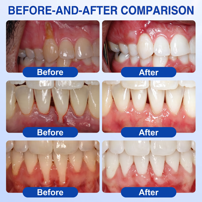 Glimmerly® GumRevive periodontal repair gel✨