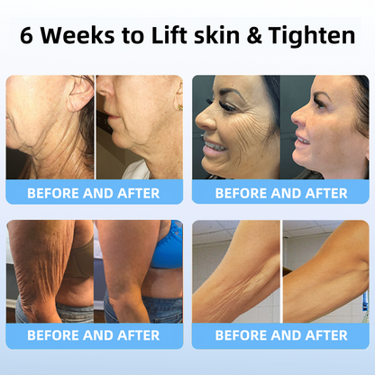 🔥👩‍⚕️𝐋𝐚𝐬𝐭 𝐃𝐚𝐲 𝐃𝐢𝐬𝐜𝐨𝐮𝐧𝐭: 𝟕5% 𝐎𝐅𝐅✨𝑺𝑷𝒁𝑽™ 𝑺𝒌𝒊𝒏 𝑳𝒊𝒇𝒕𝒊𝒏𝒈 𝑾𝒓𝒊𝒏𝒌𝒍𝒆 𝑹𝒆𝒎𝒐𝒗𝒂𝒍 𝑪𝒓𝒆𝒂𝒎 : Restore Skin Elasticity