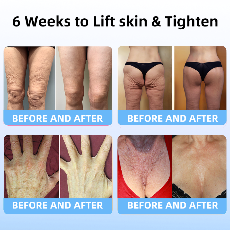 🔥👩‍⚕️𝐋𝐚𝐬𝐭 𝐃𝐚𝐲 𝐃𝐢𝐬𝐜𝐨𝐮𝐧𝐭: 𝟕5% 𝐎𝐅𝐅✨𝑭𝒖𝒃𝒔𝒕𝒂® 𝑨𝒅𝒗𝒂𝒏𝒄𝒆𝒅 𝑭𝒊𝒓𝒎𝒊𝒏𝒈 & 𝑾𝒓𝒊𝒏𝒌𝒍𝒆-𝑹𝒆𝒅𝒖𝒄𝒊𝒏𝒈 𝑪𝒓𝒆𝒂𝒎 : Restore Skin Elasticity