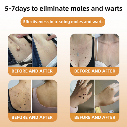 🕊️𝑻𝒖𝒓𝒐𝒏𝒖™  Bee Venom Wart & Tag Removal Cream( skin types) promotion 60% off)Suitable for allLast day