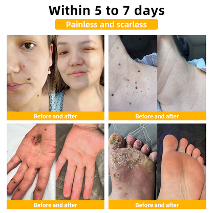 𝑻𝒖𝒓𝒐𝒏𝒖™  Bee Venom Wart & Tag Removal Cream( skin types) promotion 60% off)Suitable for allLast day🦅