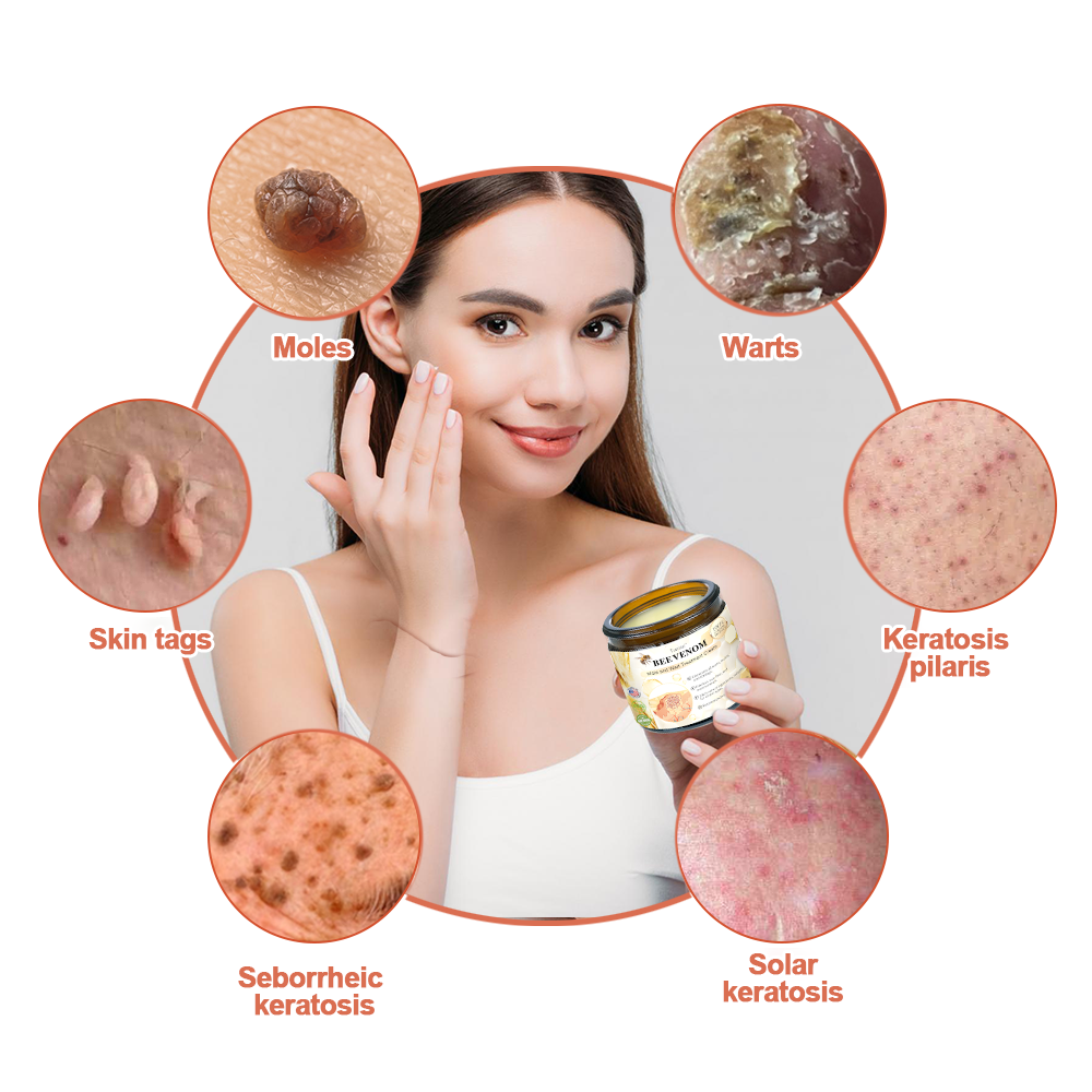 🕊️𝑻𝒖𝒓𝒐𝒏𝒖™  Bee Venom Wart & Tag Removal Cream( skin types) promotion 60% off)Suitable for allLast day
