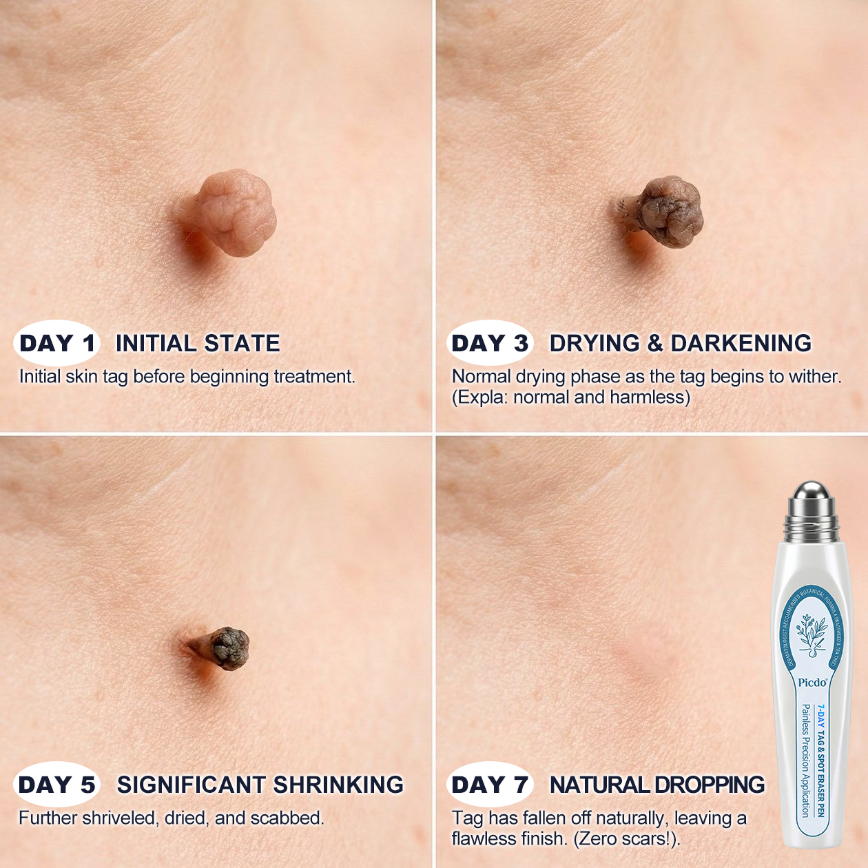𝐏i𝐜𝐝o®🥇7-𝐷𝑎𝑦 𝗧𝐚𝐠 & 𝗦𝗽𝐨𝐭 𝐄𝐫𝒂𝒔𝒆𝒓🍀(Zero Pain, Zero 𝐒𝐜𝐚𝒓𝒔 Rollerball)