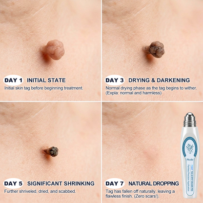 𝐏i𝐜𝐝o®🥇7-𝐷𝑎𝑦 𝗧𝐚𝐠 & 𝗦𝗽𝐨𝐭 𝐄𝐫𝒂𝒔𝒆𝒓🍀(Zero Pain, Zero 𝐒𝐜𝐚𝒓𝒔 Rollerball)